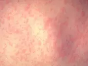 Measles Outbreak in Quebec: Montreal Confirms First Case, Total Rises to 7