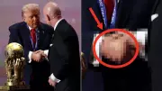 Trump's Bruised Hand Sparks Health Questions at FIFA Event