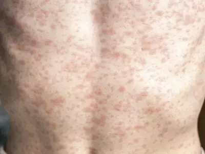 PAHO Urges Canada to Strengthen Measles Vaccination Amid Rising Cases