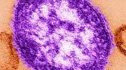 Measles Cases Surge in Manitoba, Officials Issue Exposure Warning