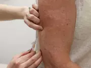 Measles Exposure Alert at Montreal Airport After Infected Traveler Arrives from Mexico