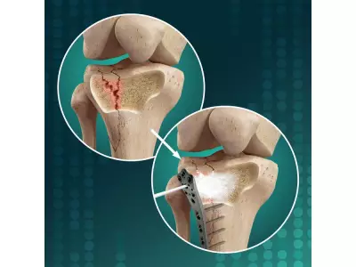 Biomimetic Innovations Ltd Announces Clinical Study for OsStic™ Bone Filler in Tibial Fractures