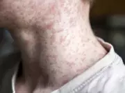 Alberta Health Services Issues Measles Exposure Alert Across Multiple Cities