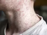 Alberta Issues Measles Exposure Alert for Calgary Airport and Bus Terminals