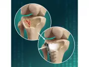 Biomimetic Innovations Ltd Announces Clinical Study for OsStic™ Bone Filler in Tibial Fractures