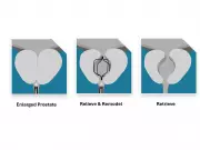 Prodeon Medical's Urocross System Receives FDA Clearance for BPH Treatment