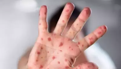 Measles Case Confirmed at Galeries Joliette in Lanaudière