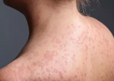 Measles Case Confirmed in Quebec City, Public Health Issues Alert