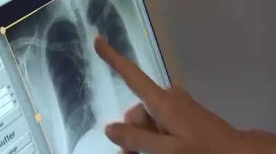 Saskatchewan Health Authority Defends TB Response Amid Ongoing Northern Outbreak