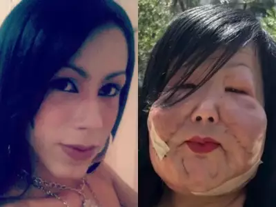 Transgender Influencer Undergoes Breast Surgery After Botched Fillers