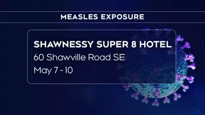 Measles Exposure Alert Issued in Calgary by Alberta Health Officials