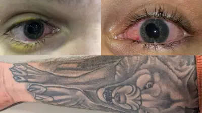 Tattoo-Related Uveitis: New Study Links Ink to Vision Loss