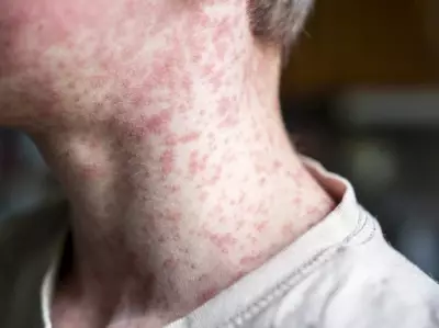 Toronto Public Health Warns of Measles Exposure in West End Locations