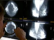 Breast Cancer Rates Vary Across Canada: Highest in Atlantic Provinces