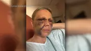 CTrain Attack Victim Speaks Out: ‘I Got Beaten’ in Calgary