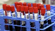 Halifax Residents Frustrated Over Bloodwork Backlog Issues