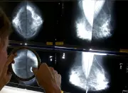 High Breast Cancer Rates in Canadian Regions: Study