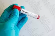 Red Deer Seniors Facility Visitors Warned of Possible Measles Exposure