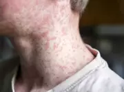 Toronto Public Health Warns of Measles Exposure in West End Locations