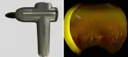 Case Report: Massage Guns Can Cause Eye Damage, Warn Doctors