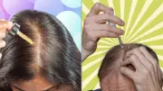 Minoxidil for Hair Loss: Dermatologists Warn Against Preventive Use