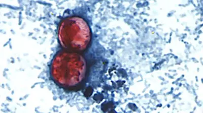 Michigan Cyclospora Outbreak Nears 1,000 Cases, Largest in State History