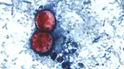 Michigan Cyclospora Outbreak Nears 1,000 Cases, Largest in State History
