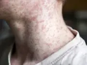 Toronto Public Health warns of measles exposures in Scarborough